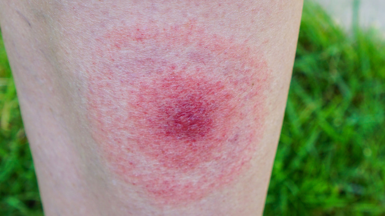 Bullseye rash closeup