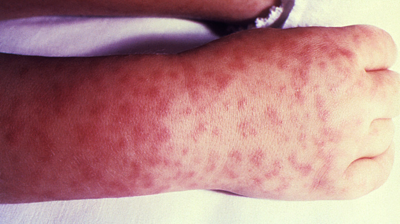 Rocky Mountain spotted fever rash