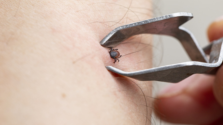 Removing a deer tick with tweezers
